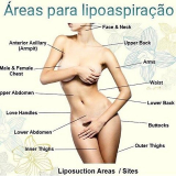 Abdominoplastia com Lipoescultura
