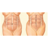 abdominoplastia acima do peso preço São Paulo
