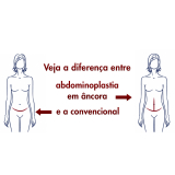 abdominoplastia acima do peso Santo Amaro