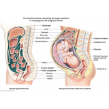 abdominoplastia após cesárea Morumbi