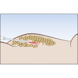 abdominoplastia com lipo São Paulo