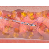 abdominoplastia com lipoescultura São Paulo