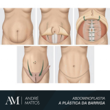 abdominoplastia e mamoplastia Santo Amaro