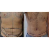 abdominoplastia em homem preço Taboão da Serra