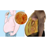 abdominoplastia masculina preço Santo Amaro