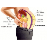 abdominoplastia masculina Taboão da Serra