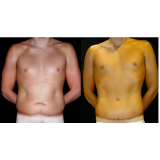 abdominoplastia para homem Taboão da Serra