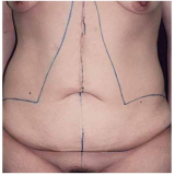 abdominoplastia para obesos preço Vila Andrade