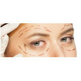 blefaroplastia bilateral preço Taboão da Serra