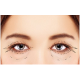 blefaroplastia bilateral valor Taboão da Serra