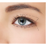 blefaroplastia bilateral Morumbi