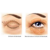 Blefaroplastia Bilateral