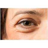 blefaroplastia bolsa de gordura preço Santo Amaro