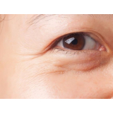 blefaroplastia bolsa de gordura Taboão da Serra