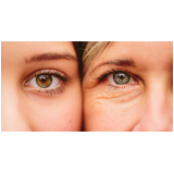 blefaroplastia cirurgia preço São Paulo