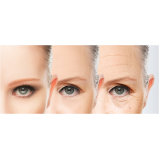 blefaroplastia cirurgia valor Taboão da Serra