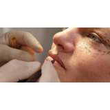 blefaroplastia e botox preço Taboão da Serra