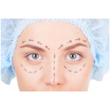 blefaroplastia e botox Taboão da Serra