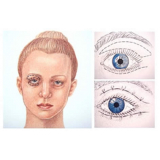 blefaroplastia superior preço Taboão da Serra