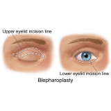 blefaroplastia superior Taboão da Serra