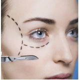 cirurgia blefaroplastia inferior preço Taboão da Serra
