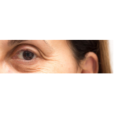 cirurgia blefaroplastia superior preço Santo Amaro
