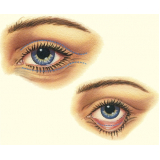 cirurgia blefaroplastia superior valor Vila Andrade
