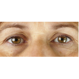 cirurgia de blefaroplastia superior valor São Paulo