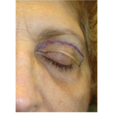 cirurgia de blefaroplastia superior Morumbi