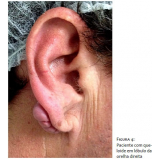 cirurgia de queloide na orelha valor São Paulo