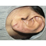 cirurgia de rasgo na orelha preço Taboão da Serra