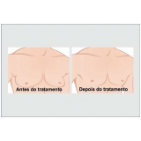 cirurgia ginecomastia grau 2 valor Taboão da Serra