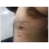 cirurgia ginecomastia grau 2 Vila Andrade