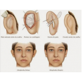 cirurgia na orelha São Paulo