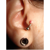 cirurgia para queloide na orelha preço Santo Amaro