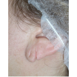 cirurgia para rasgo na orelha valor Vila Andrade