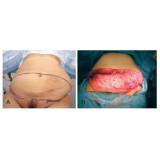 cirurgia plástica abdominal preço São Paulo