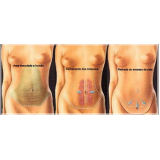 cirurgia plástica abdominal Santo Amaro