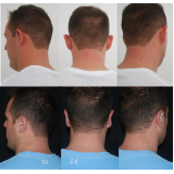 Cirurgia Plástica Orelha