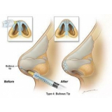 Cirurgia Plástica Rinoplastia