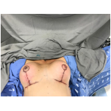 cirurgia plástica levantar mama Morumbi