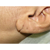 cirurgia plástica para rasgo na orelha preço Santo Amaro