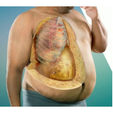 cirurgia plástica pós bariátrica preço Santo Amaro