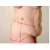 cirurgia plástica pós bariátrica Taboão da Serra