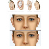 Cirurgia na Orelha