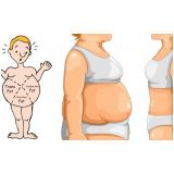 clínica de abdominoplastia acima do peso Vila Andrade