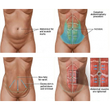 clínica de abdominoplastia após cesárea Vila Andrade