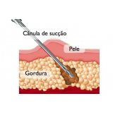 clínica de abdominoplastia com lipo São Paulo
