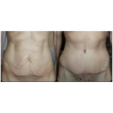clínica de abdominoplastia para homem São Paulo