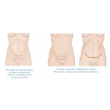 clínica de abdominoplastia para reduzir medidas São Paulo